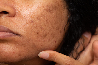Pigmentation on skin