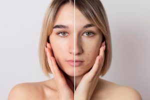 Why Pigmentation Returns—and How Lasers Can Help
