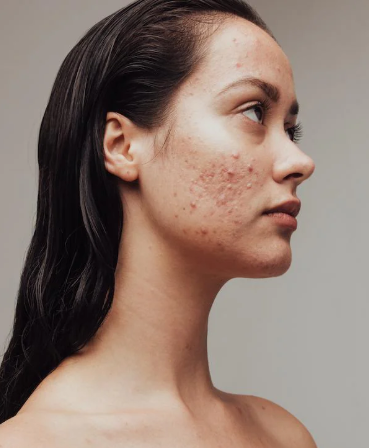 Sensitive skin concern